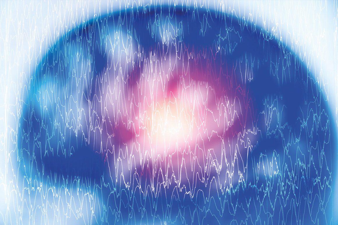 Crisi epilettiche dopo un ictus: quando trattare, per quanto tempo e con  cosa? - Medizinonline, image size:1160x774